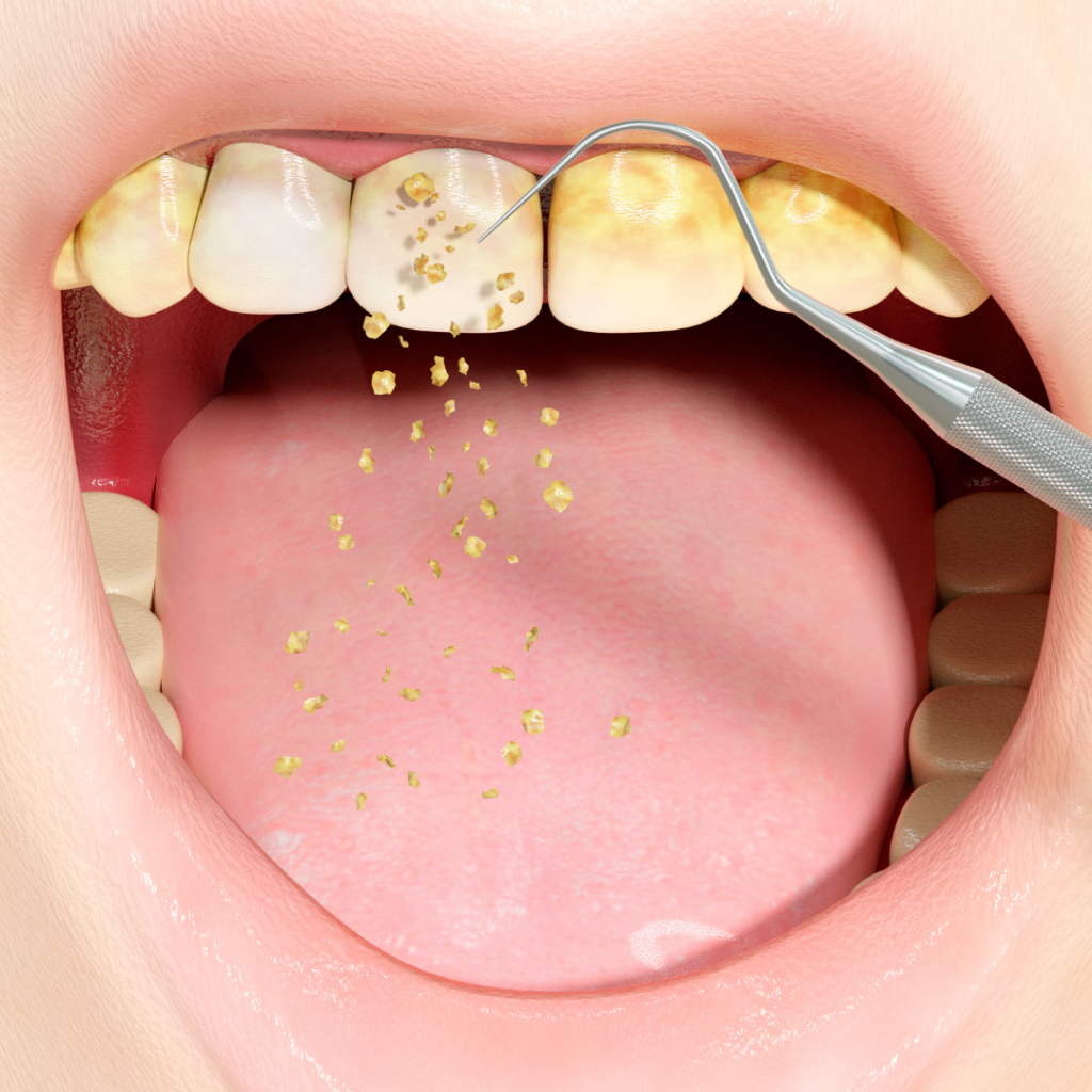 Placa y Sarro en la Dentadura: Amenazas Silenciosas para la Salud Oral